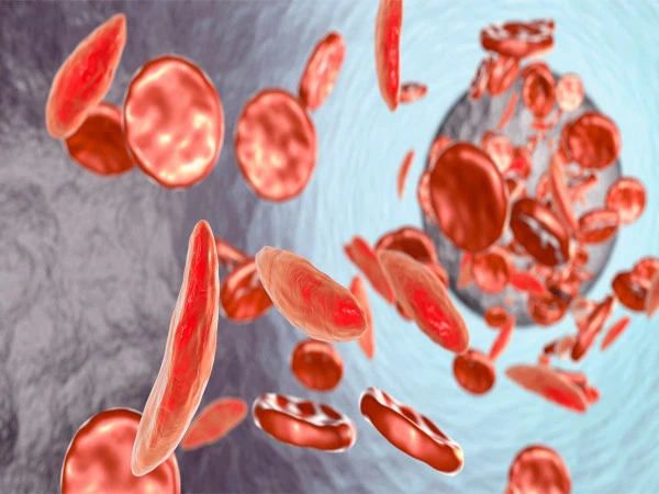 New Study: Anemia in Adults May Be Early Warning Sign of Cancer